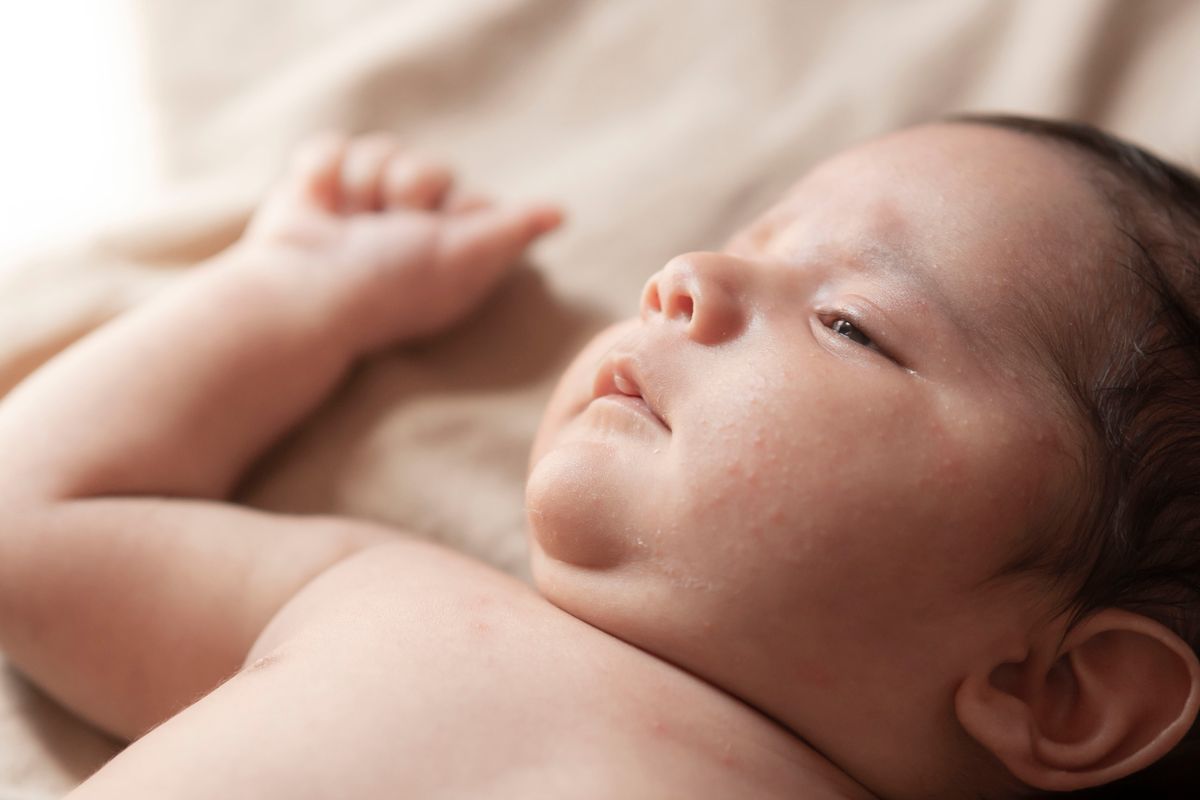 Da trẻ sơ sinh khô, bong tróc và cứt trâu: cách chăm và dưỡng ẩm đúng